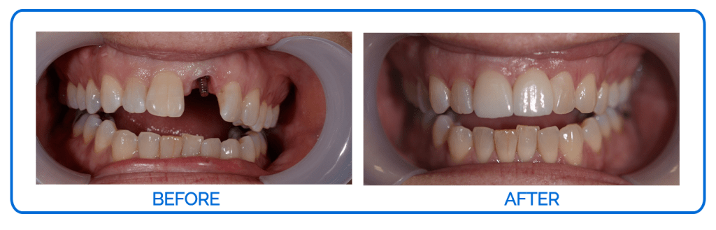 Implant Before & After